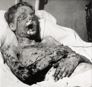 Smallpox Victim